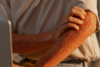 Herpes Zoster e os Condôminos